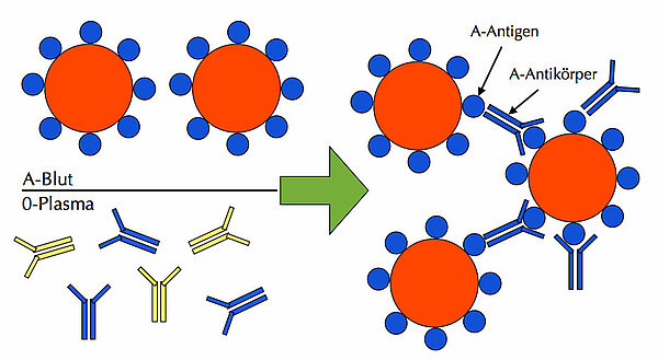 Blut der Blutgruppe A wird mit Plasma der Blutgruppe 0 gemischt